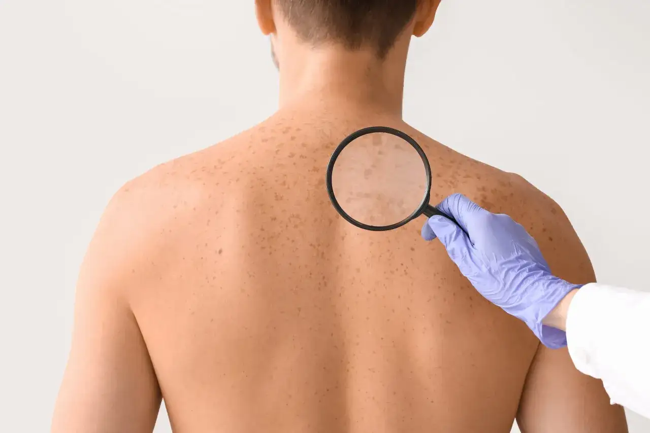 Dermatolog bada plecy pacjenta z licznymi przebarwieniami, kt&oacute;re mogą wskazywać na grzybicę sk&oacute;ry. Białe plamy są widoczne pod lupą.